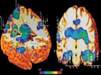 Meth Use and Brain Abnormalities