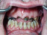 Grant Issued to Help Identify Meth Mouth In Beginning Stages