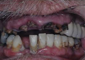 bad teeth from meth use